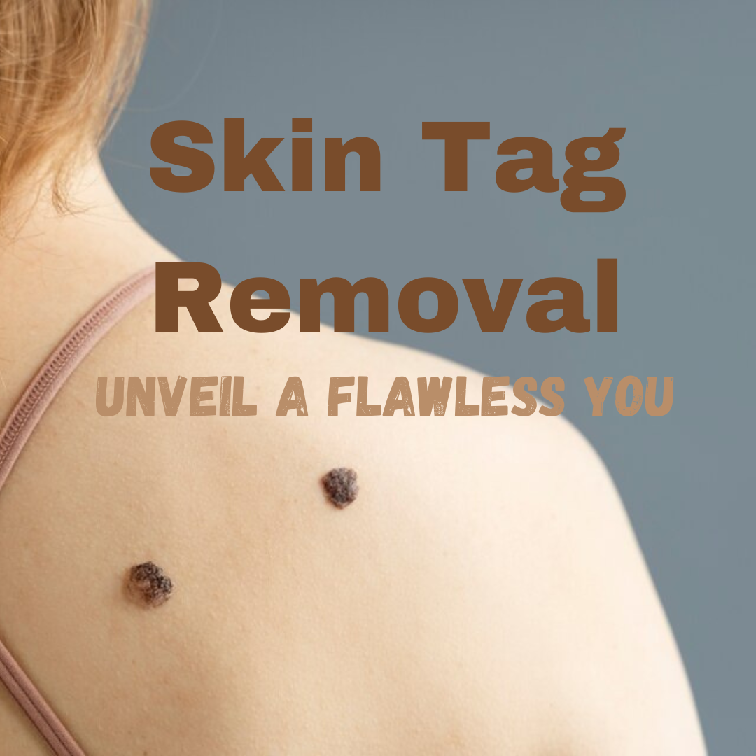 skin-tag-removal-erase-the-negative-with-7-proven-methods-only